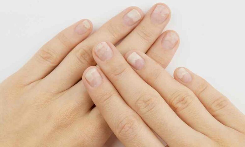 Tırnaklarımız sağlığımız hakkında önemli ipucu veriyor!