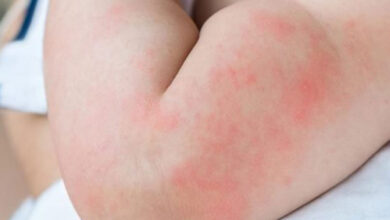 Sıcaklar kurdeşene neden olabilir