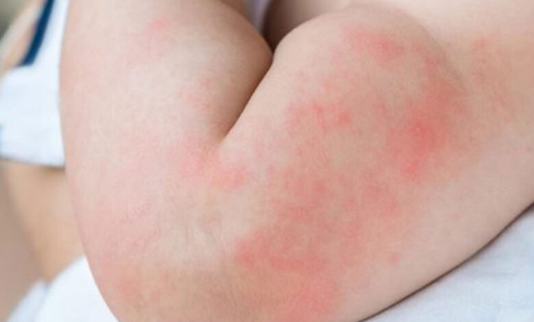 Sıcaklar kurdeşene neden olabilir